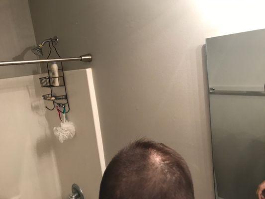 Bald spot on the back