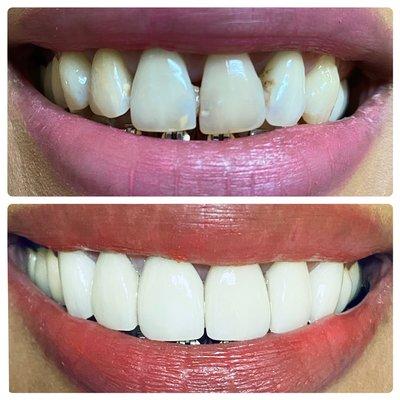 Before and after 6 porcelain veneers!