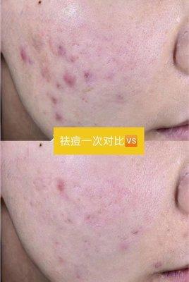 Acne Scar treatment before and after