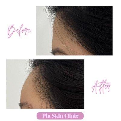 Filler Procedure to add volume for more rounded appearance