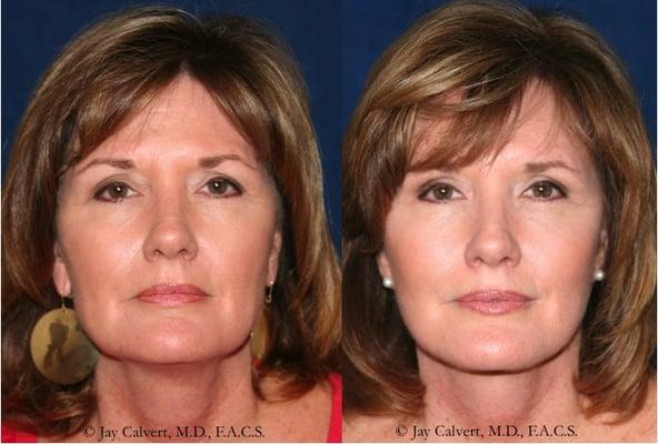 Full facelift by Dr. Jay Calvert