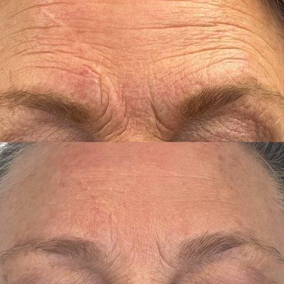 Before and after one rejuvapen micro needling skin tightening and skin resurfacing treatment.