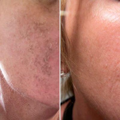 Chemical peel