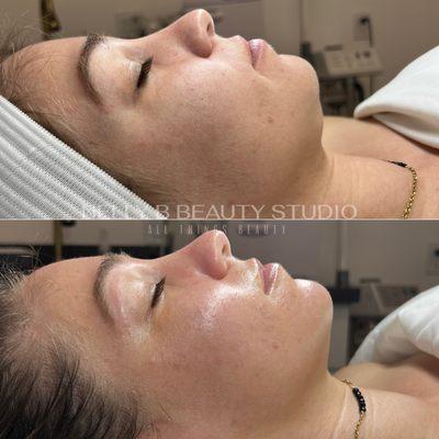 Hydrafacial glow