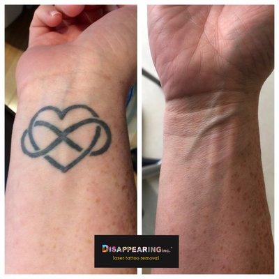 Placement is everything. We removed this infinity heart from our client's wrist.