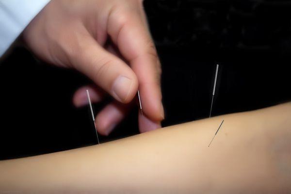 Natuever Acupuncture