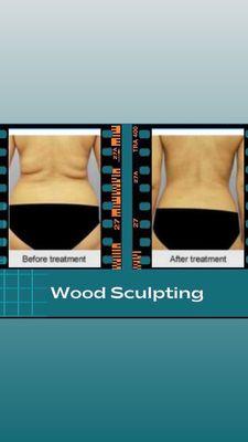 Wood therapy is used for stubborn fat