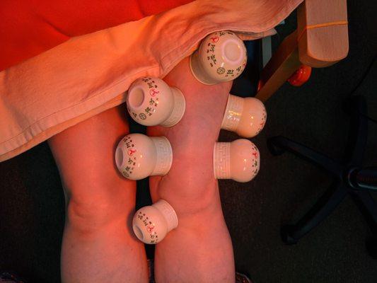 Warm cupping with Ceramic cups for knee pain.