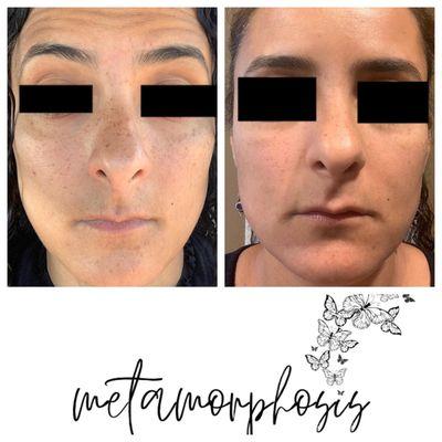 Before & after Rejuvapen NXT microneedling with Factor Five serum.