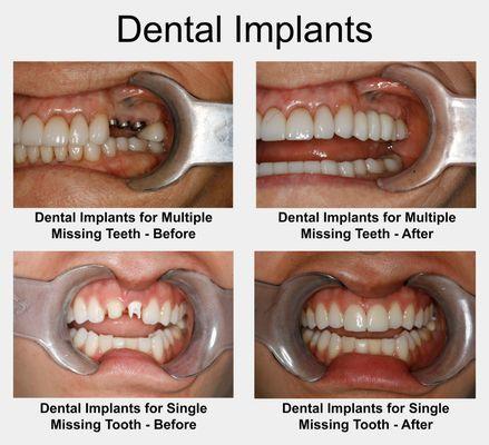 Dental Implants