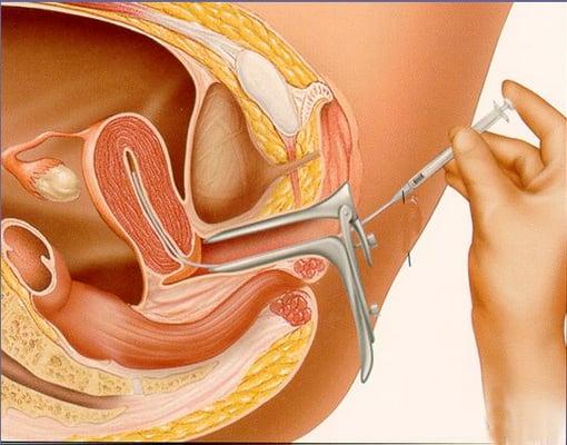 Intrauterine insemination (IUI)