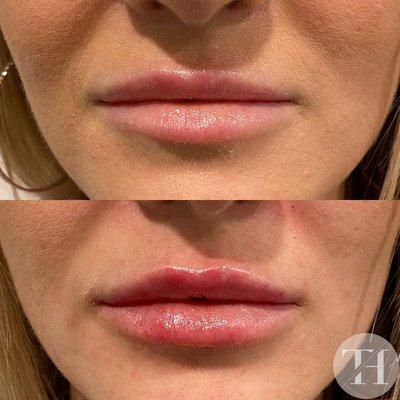 Naturally shaped lips with a little refining using Restylane Kysse.