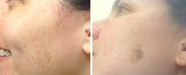 Hyper Pigmentation Treatment