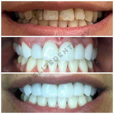 Full mouth Porcelain Veneers/Crowns on the upper arch and Zoom Teeth whitening on the lower arch.