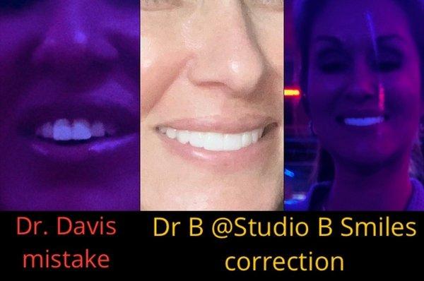 Left: The poor results I was left with after Dr. Davis  Middle & Right: The great results after repairs by Dr. B at Studio B Smiles