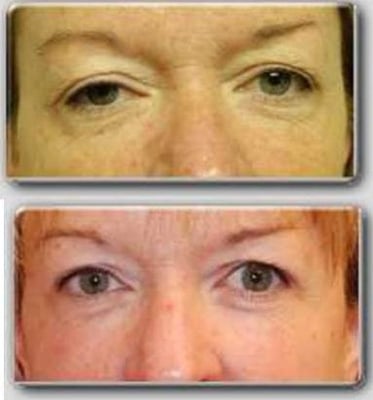 Fractional Laser Resurfacing is the "medical breakthrough of the Decade" - Webb MD.  It reduces lines, discolorations and scars.