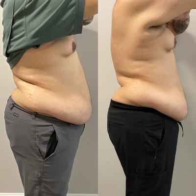 Before and after - 4 sessions of CryoSlimmimg