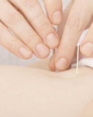 Painless Acupuncture