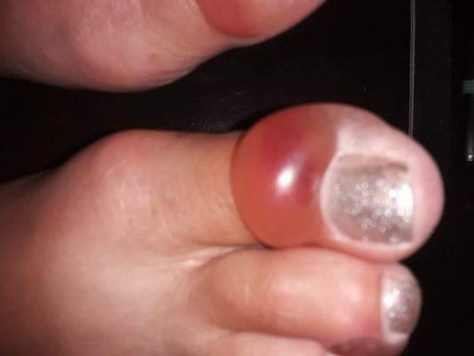 This is awhat happened to my toes 48hrs after receiving a pedicure at French Nails. PA19033. I'm on 10days of antibiotics for infection!