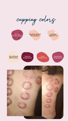 Cupping marks and their meaning