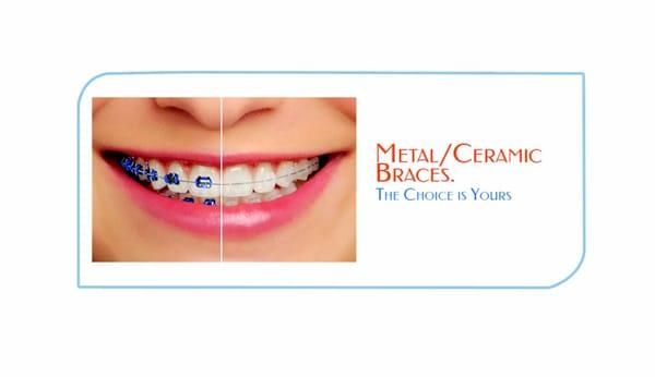 Metal & Ceramic Braces Available