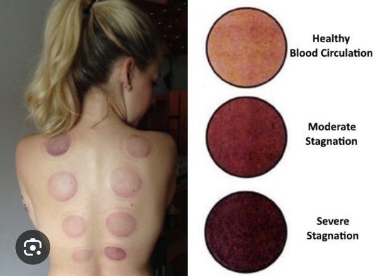 Different colors of cupping marks