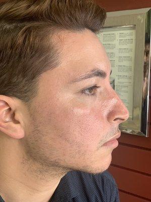 After the pore suction/ laser treatment.