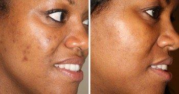 Hyperpigmentation treatment.