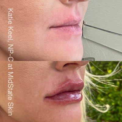 Restylane Kysse lip filler