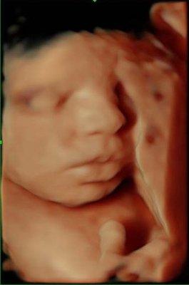 3D/4D/HD Live Ultrasound