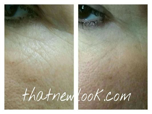 Before and after two sessions of micro skin needling sessions