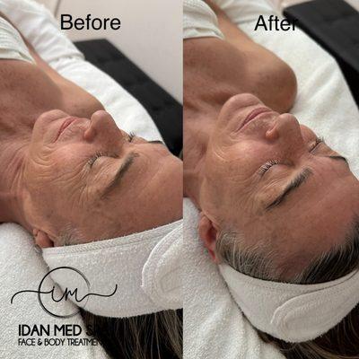 Before and after Non Surgical facelift treatment