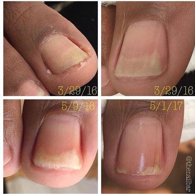 Guaranteed Results!!..treatment for nail fungus