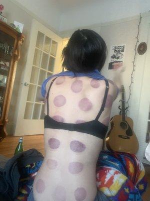 Cupping!!! It works!!!