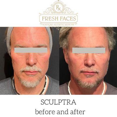 Sculptra rejuvenation