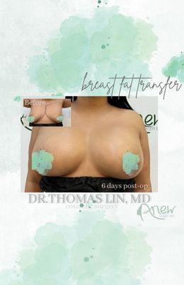 Fat transfer to breast