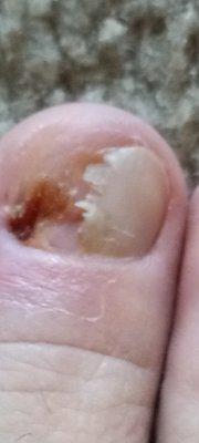 Big toe, right foot. totally wrecked