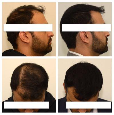 Hair Transplant Before and After Photos