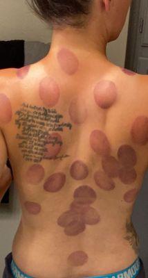 After one of my amazing cupping treatments!