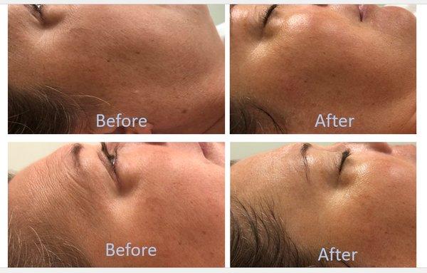 Wonderful results after one treatment. Anti-aging facial.