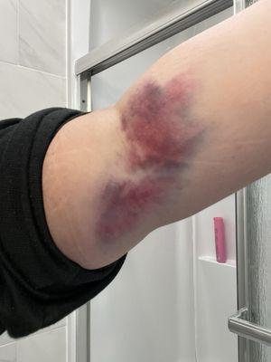 Bruise