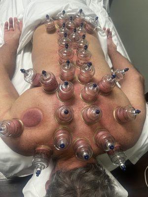 Cupping are relief back pain immediately.