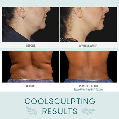 Amazing Coolsculpting results!