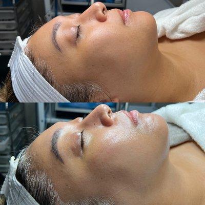 Before and After HydraFacial + Dermaplane