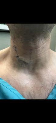 Neck surgery