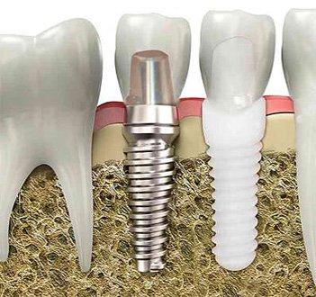 we specialize in both titanium and ceramic implants.