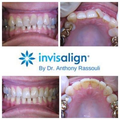 Enhance your smile with Invisalign!