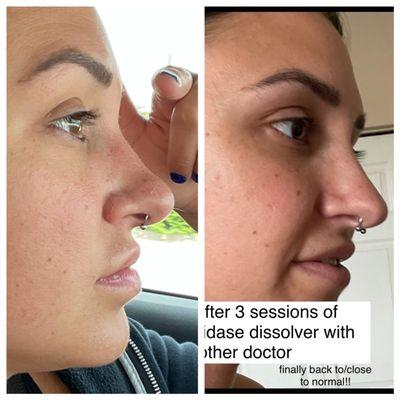 difference between dr. stanciu liquid rhinoplasty and after having it dissolved 3 separate times with another doctor.