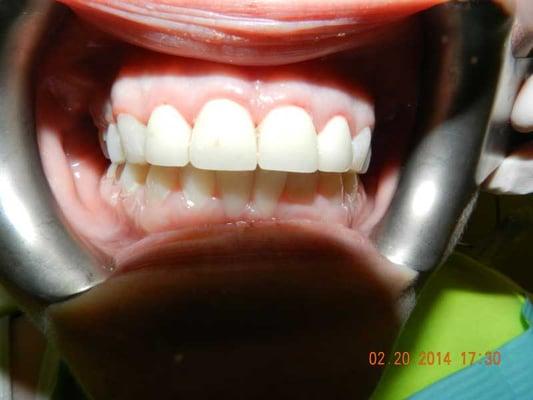 Patient had some crowns, fillings and bleaching.