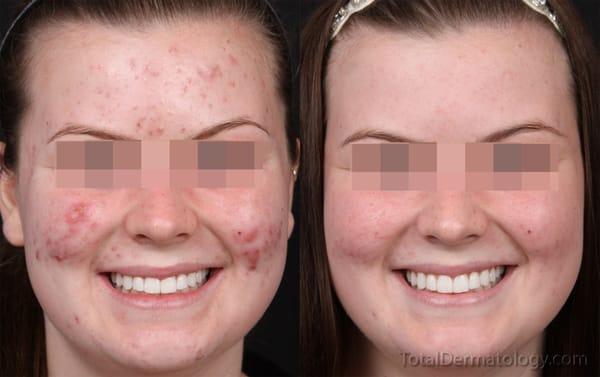 Before and after extractions & light treatments for acne